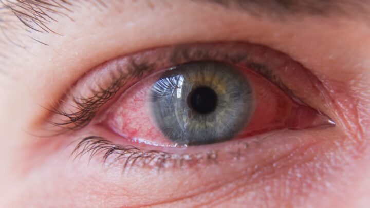 Conjuntivitis: ojo rojo, picor, sensación arenosa, sensibilidad a la luz y mayor lagrimeo